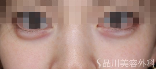症例NO.70530のAFTER写真