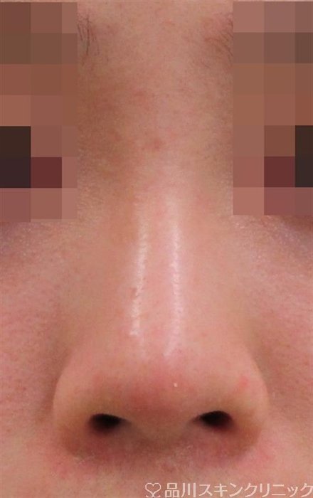症例NO.32662のBEFORE写真
