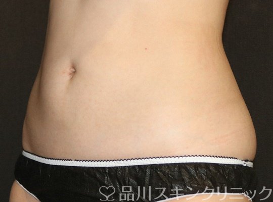 症例NO.74382のAFTER写真