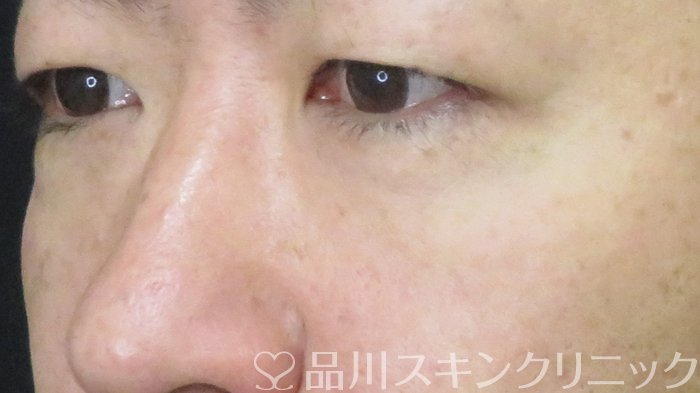 症例NO.70977のAFTER写真