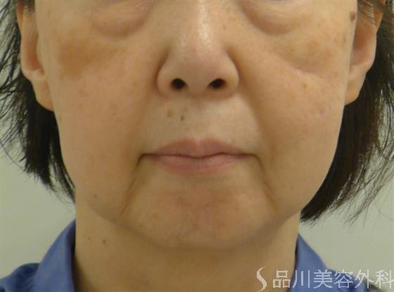 症例NO.58300のBEFORE写真