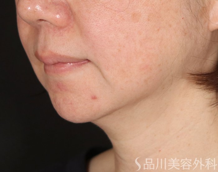 症例NO.72542のBEFORE写真