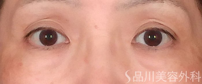 症例NO.70126のBEFORE写真