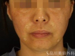 症例NO.70996のAFTER写真