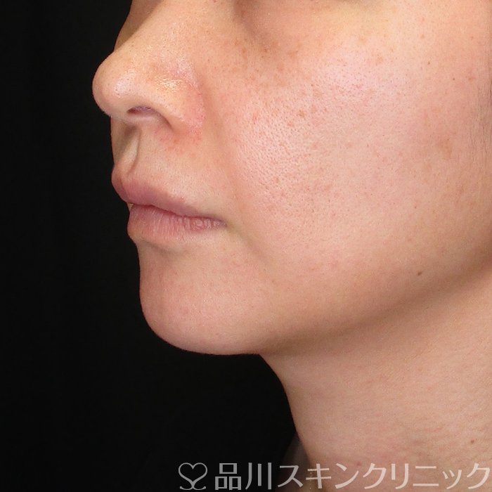 症例NO.74534のBEFORE写真