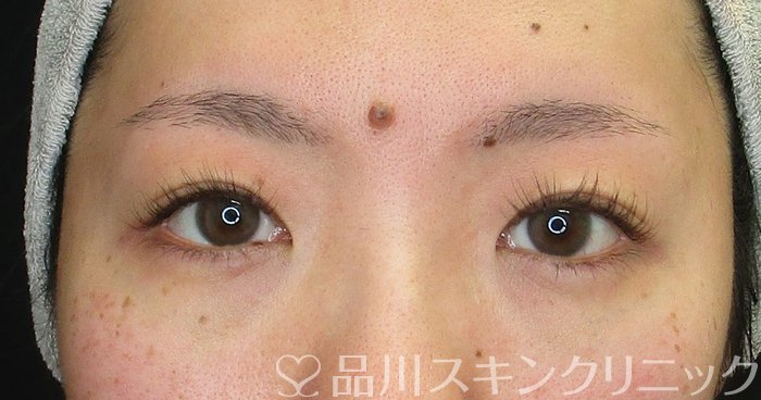 症例NO.73341のBEFORE写真