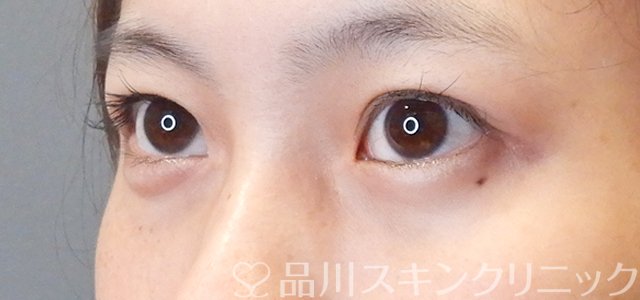 症例NO.67717のBEFORE写真