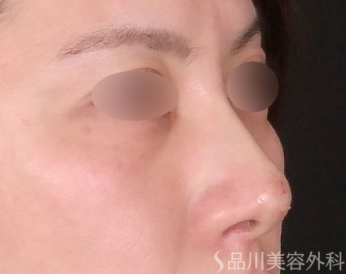 症例NO.70471のAFTER写真