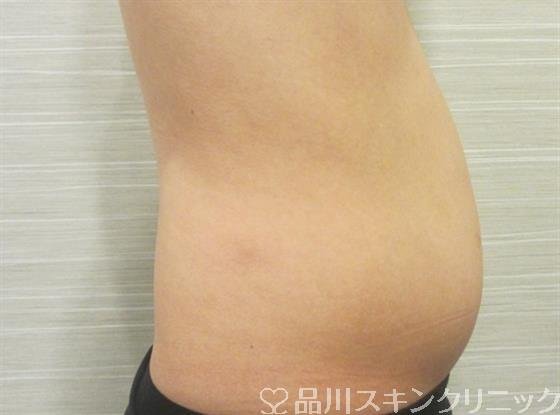 症例NO.33132のBEFORE写真