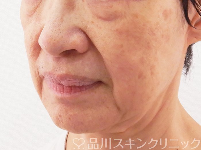 症例NO.62649のBEFORE写真