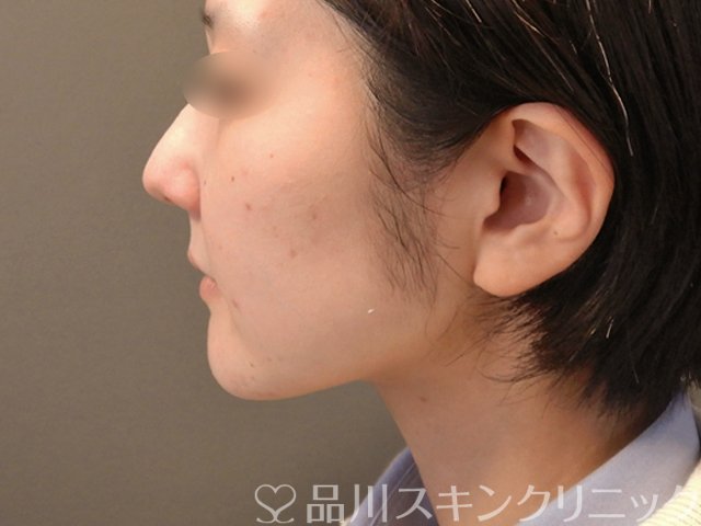 症例NO.65570のAFTER写真