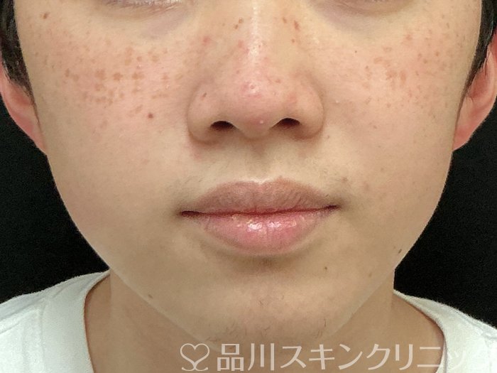 症例NO.73946のBEFORE写真