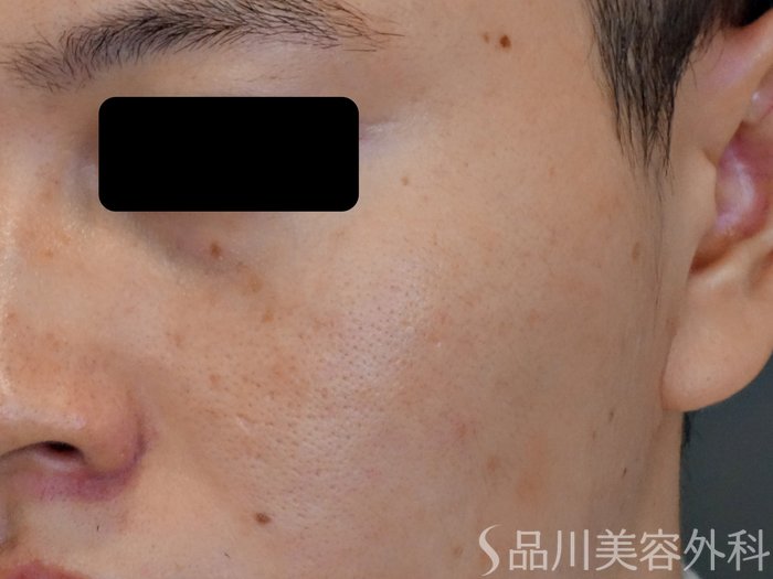 症例NO.72449のBEFORE写真