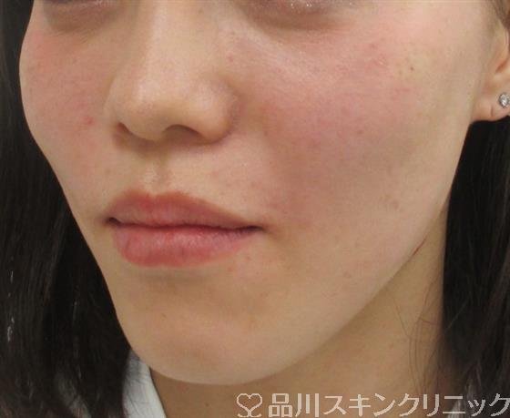 症例NO.29709のAFTER写真