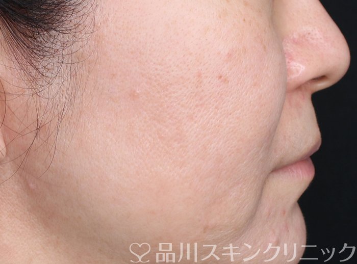 症例NO.70702のAFTER写真