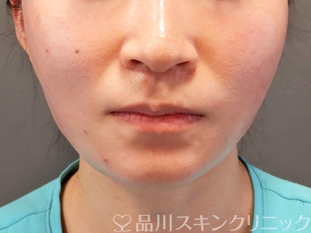 症例NO.70315のAFTER写真