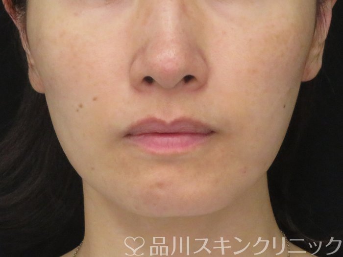 症例NO.70351のAFTER写真
