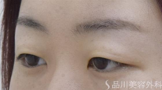 症例NO.54041のBEFORE写真