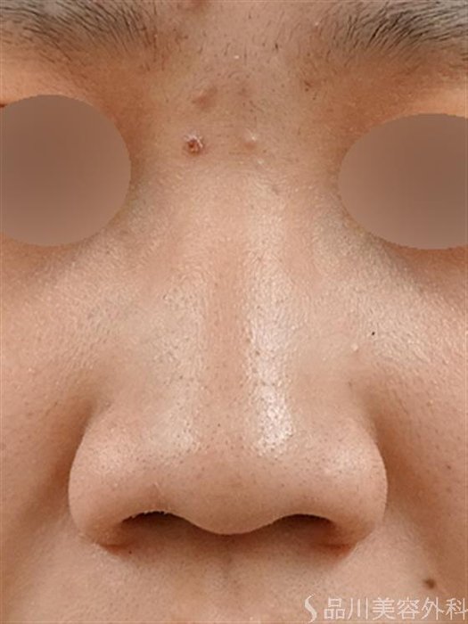 症例NO.34435のBEFORE写真