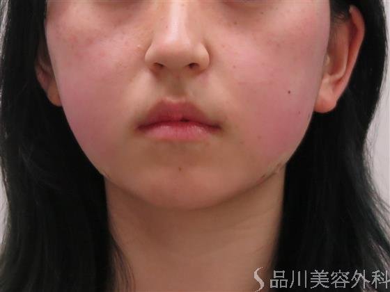 症例NO.44724のAFTER写真