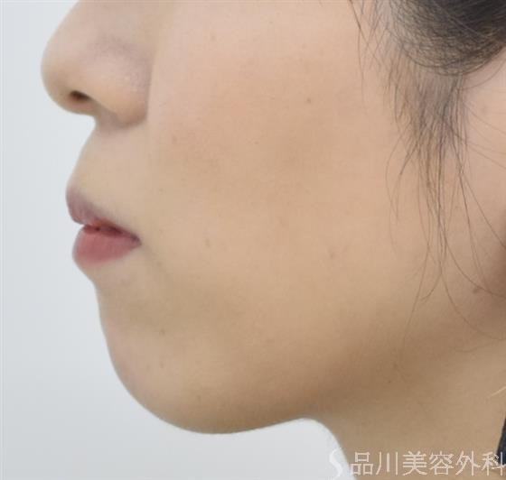 症例NO.42879のBEFORE写真