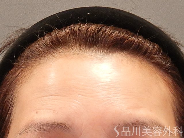 症例NO.73970のBEFORE写真