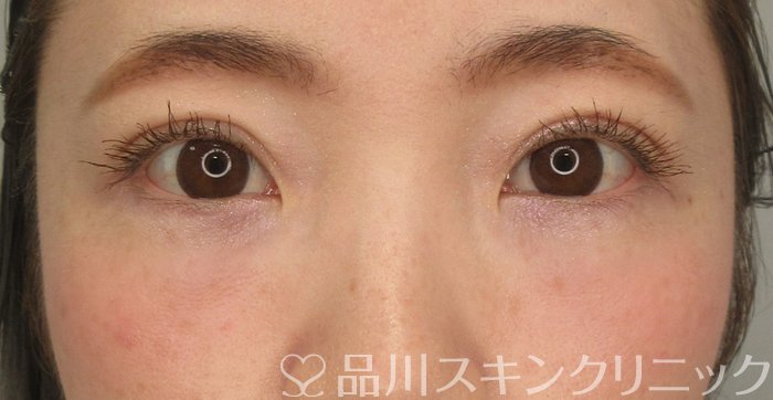 症例NO.73710のAFTER写真