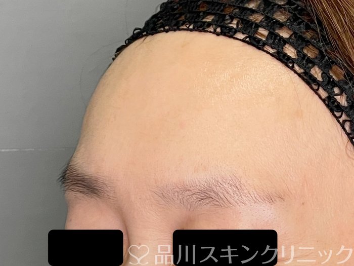 症例NO.70130のBEFORE写真