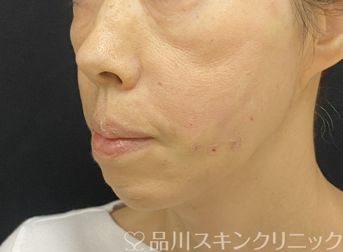 症例NO.74000のAFTER写真