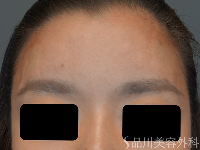 症例NO.74041のAFTER写真