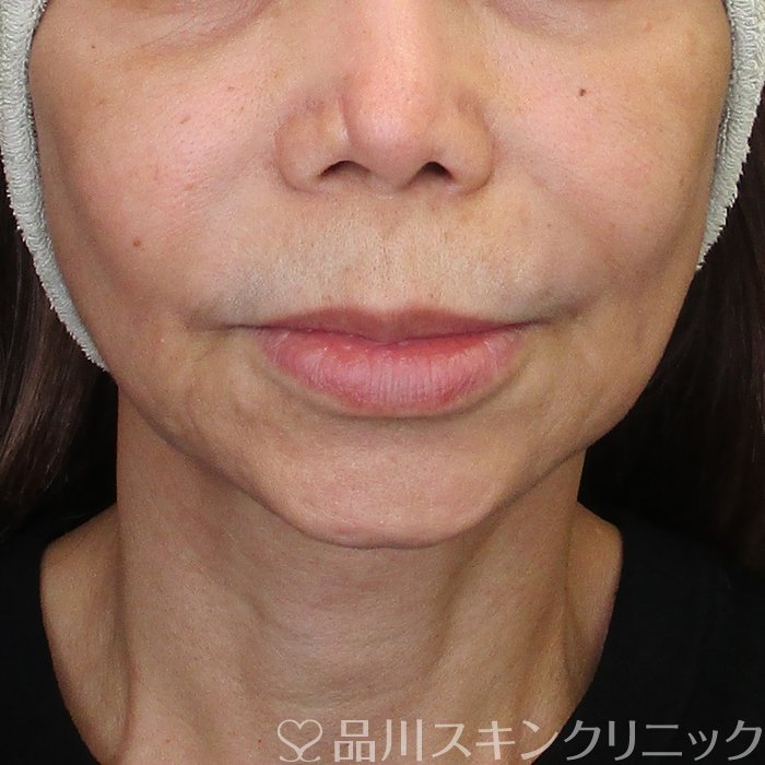 症例NO.75336のBEFORE写真