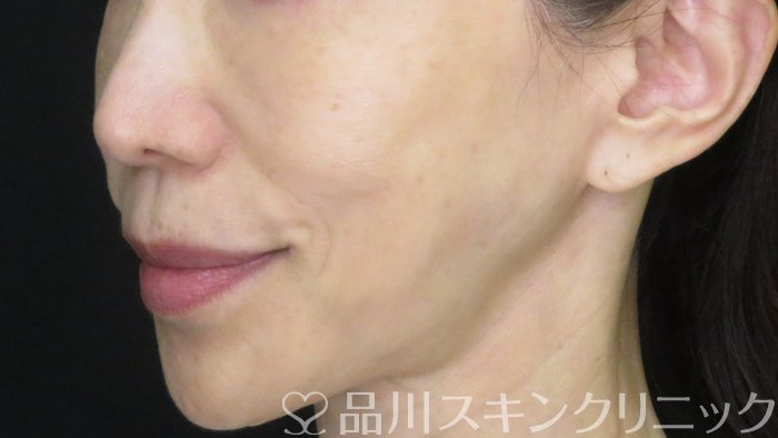 症例NO.71026のAFTER写真