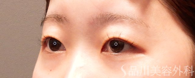 症例NO.69366のBEFORE写真
