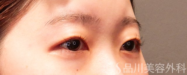 症例NO.69366のBEFORE写真