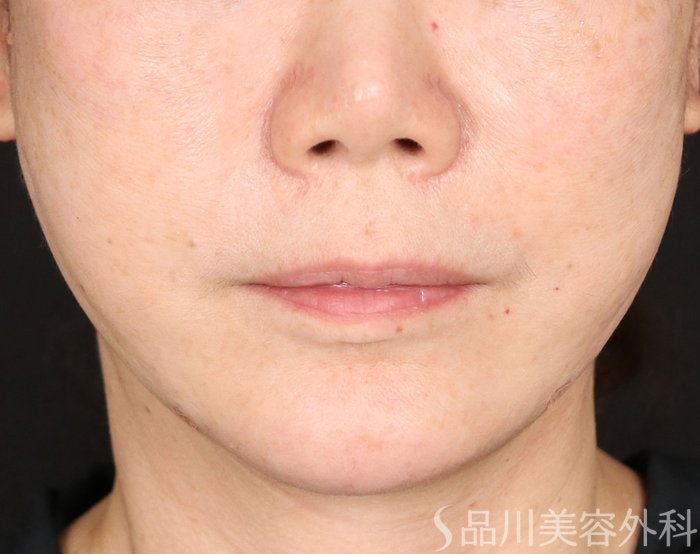 症例NO.71022のAFTER写真