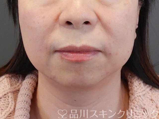 症例NO.69230のAFTER写真