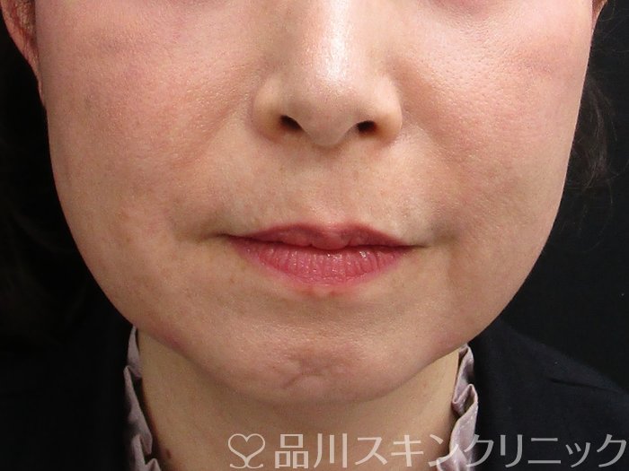 症例NO.73156のAFTER写真