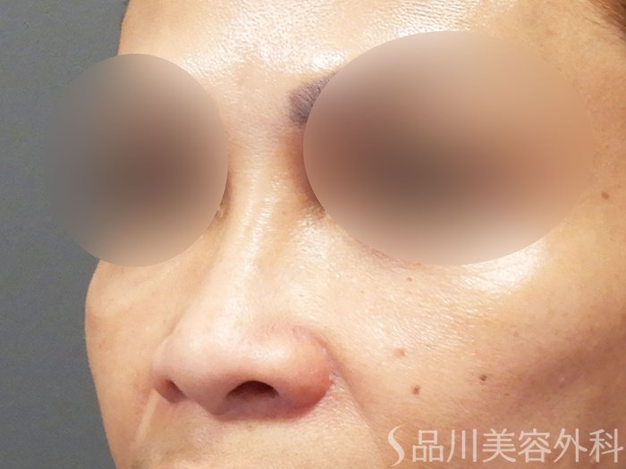 症例NO.74188のAFTER写真