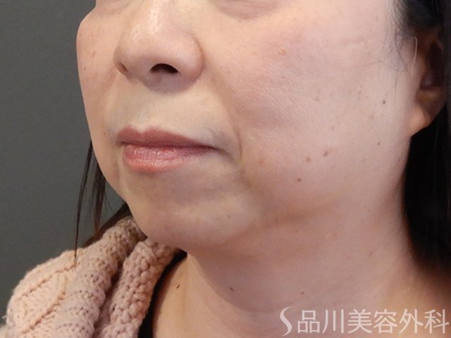 症例NO.69230のBEFORE写真