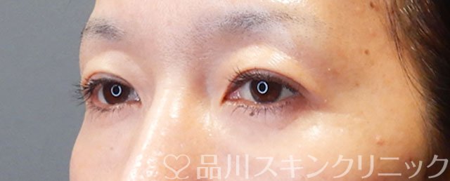 症例NO.75243のAFTER写真