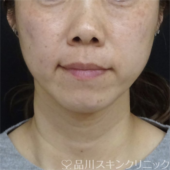 症例NO.69321のAFTER写真