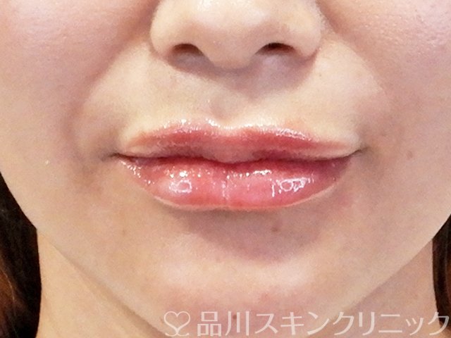 症例NO.67708のAFTER写真