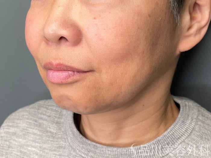 症例NO.74215のBEFORE写真