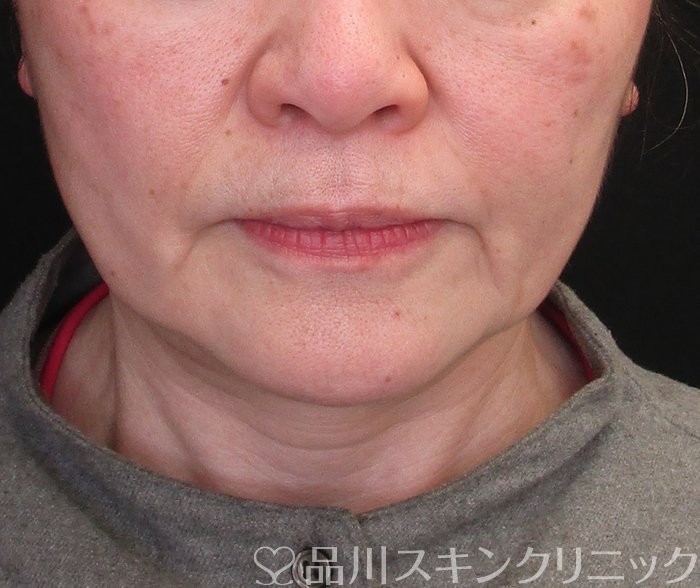 症例NO.73367のBEFORE写真