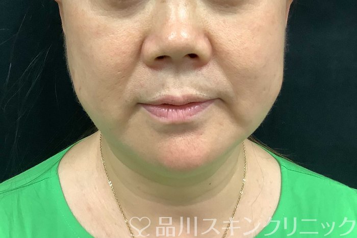 症例NO.71283のBEFORE写真