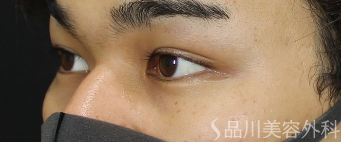 症例NO.72188のBEFORE写真