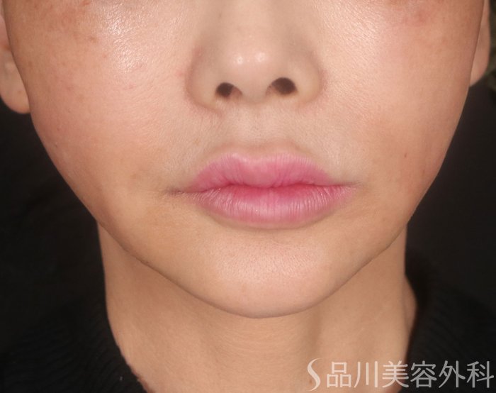 症例NO.73043のAFTER写真