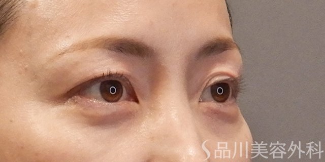 症例NO.74797のAFTER写真