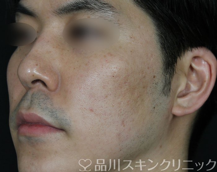 症例NO.69565のBEFORE写真