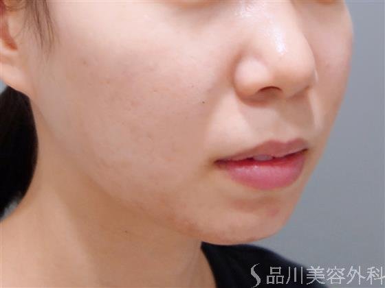 症例NO.51315のBEFORE写真